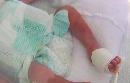 VIDA – Bebê de mãe que não sabia da gravidez ficará 3 meses internado e se alimentando por sonda