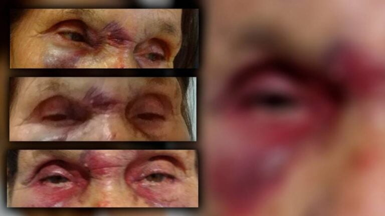 ABSURDO – Justiça põe na rua filho desocupado que esmurrou mãe idosa e fraturou nariz dela em Marília