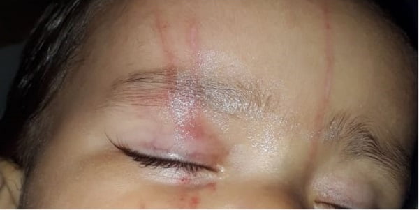 Sob investigação – BEBÊ DEIXA CRECHE COM O ROSTO TODO ARRANHADO E PROFESSORAS SÃO AFASTADAS