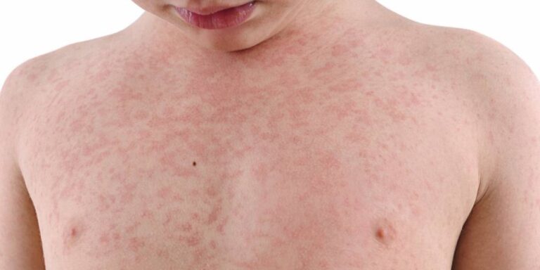 Saúde – PACIENTES COM SINTOMAS DE SARAMPO AGUARDAM RESULTADOS DE EXAMES